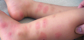 Bedbug bites och deras behandling